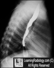 Pulmonary sling-lat